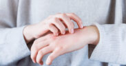 Egzema na dłoniach - przyczyny i pielęgnacja