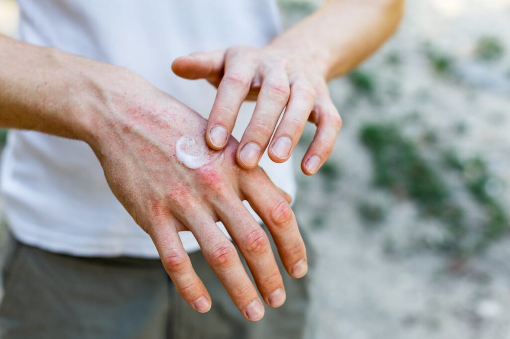 Egzema na dłoniach - przyczyny i pielęgnacja